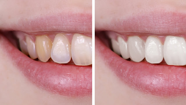 หมอฟันยังทึ่ง!! 10 วิธีกำจัดคราบฟันเหลืองได้ง่ายๆ ด้วยของใช้ใกล้ตัวแค่นี้