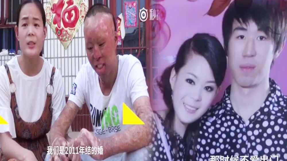 รักแท้! สาวจีนรักษาสัญญา อยู่เคียงข้างสามีที่ถูกไฟคลอกจนเสียโฉม ไม่ทอดทิ้งกัน!