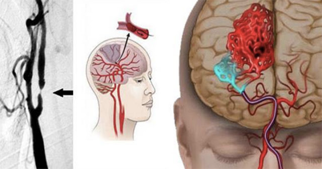 แชร์เก็บไว้มีประโยชน์มาก! 8 สัญญาณเตือน โรคเลือดออกในสมองใครมีอาการแบบนี้ ไปหาหมอด่วน