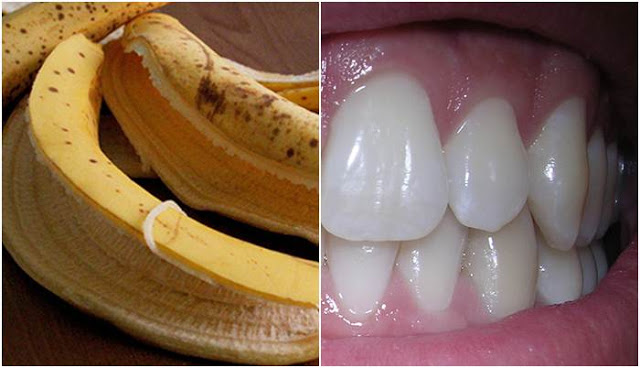 5 ขั้นตอนให้ฟันขาวแบบง่ายๆ ด้วยเปลือกกล้วย
