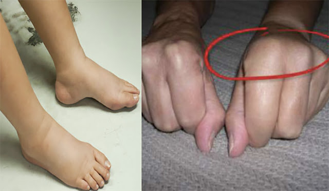 สัญญาณอันตราย!! มือ เท้าบวม ไม่ใช่แค่โรคไต ใครมีอาการแบบนี้ ควรระวัง