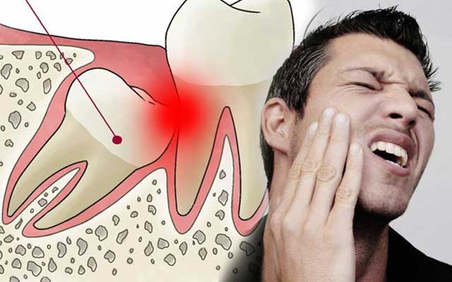 ฟันคุดคืออะไร จะทราบได้อย่างไรว่ามีฟันคุด ทำไมถึงต้องผ่าฟันคุด