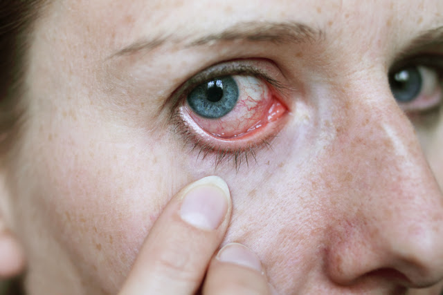 เสี่ยงตาบอด! 5 สัญญาณอันตราย ถ้าเกิดขึ้นแล้วควรหยุดใส่คอนแทคเลนส์ทันที