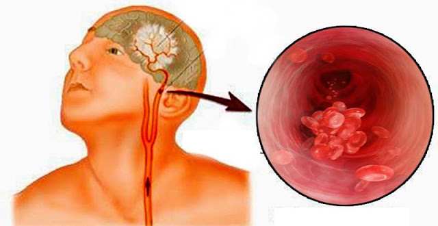 วิธีการเช็คเส้นเลือดอุดตันในสมองง่ายๆ คุณอาจช่วยชีวิตคนบางคนได้